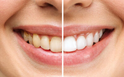 Signs That Your Teeth May Need Whitening