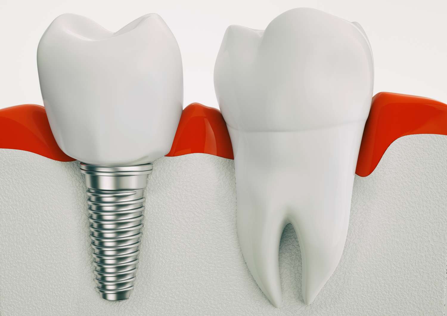 root canal1