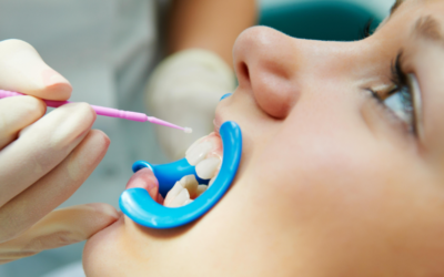 How Dental Sealants Prevent Cavities in School-Aged Children